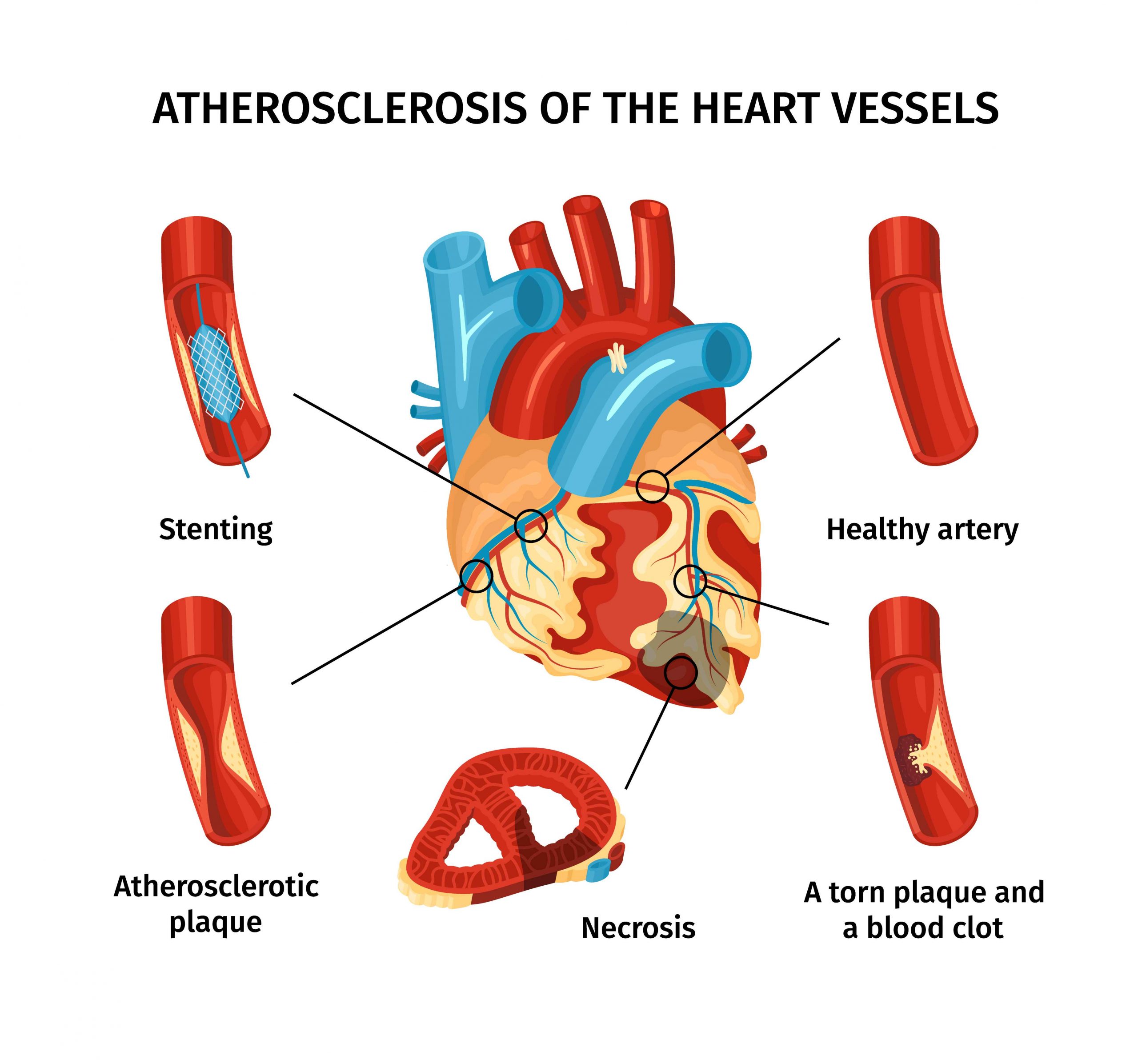 Are you worried about atherosclerosis? Here’s what you need to know.