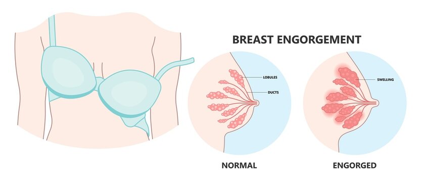 Breast Engorgement: Managing a Common Issue during Breastfeeding