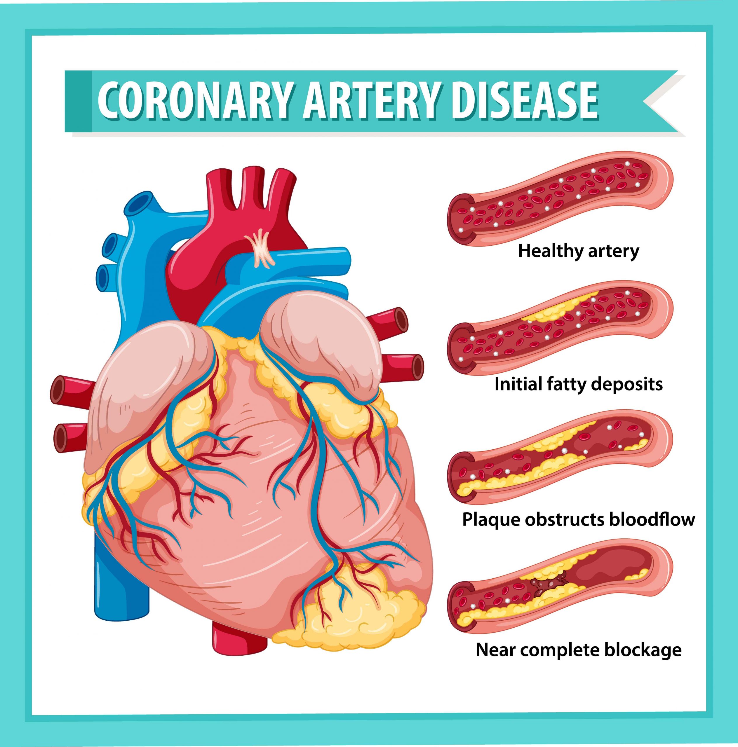 Coronary artery disease: A common heart condition that can be controlled.