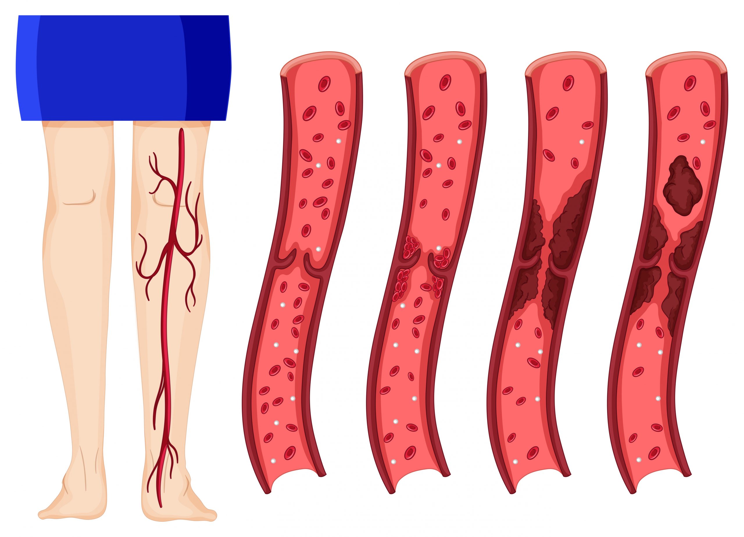 Wheels of Change: Navigating Deep Vein Thrombosis (DVT) with Wheelchair Use