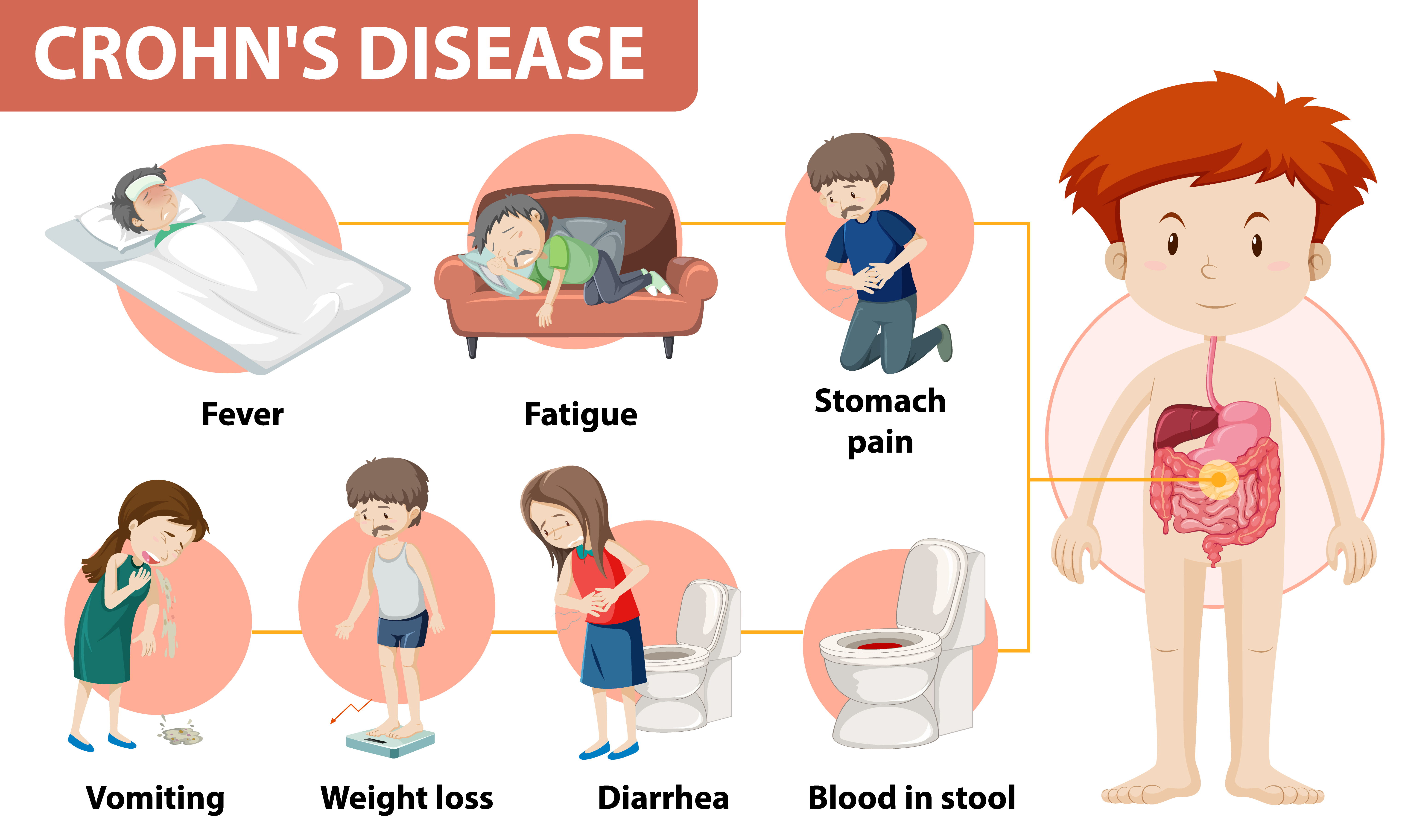 Understanding the Signs: Common Symptoms of Irritable Bowel Syndrome (IBS)