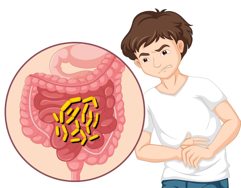 The Anatomy of Appendicitis: Understanding the Appendix