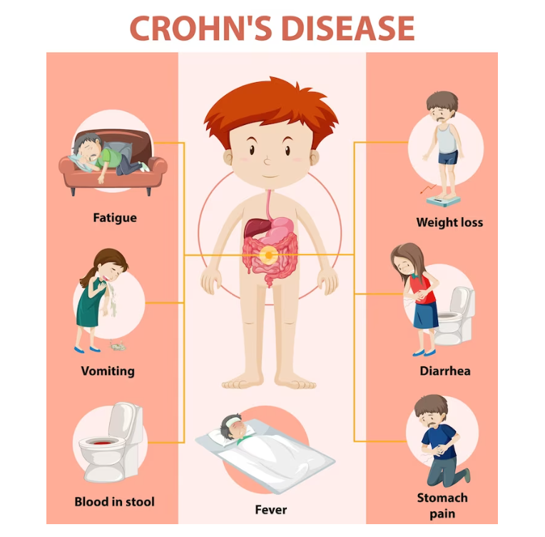 Appendicitis in Children: Unique Considerations and Symptoms