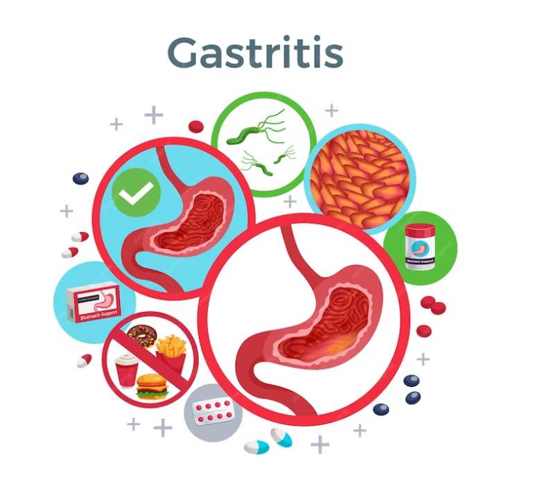 Natural Remedies for Gastritis: Tips for Soothing Symptoms