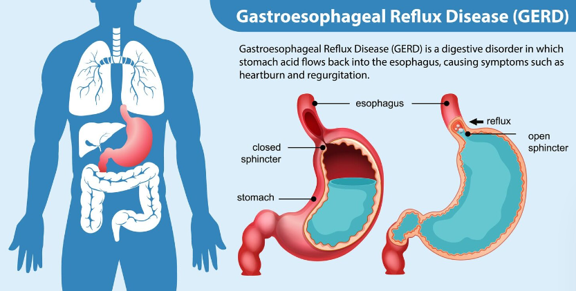 Understanding Gastroenteritis: What It Is and How It Affects You