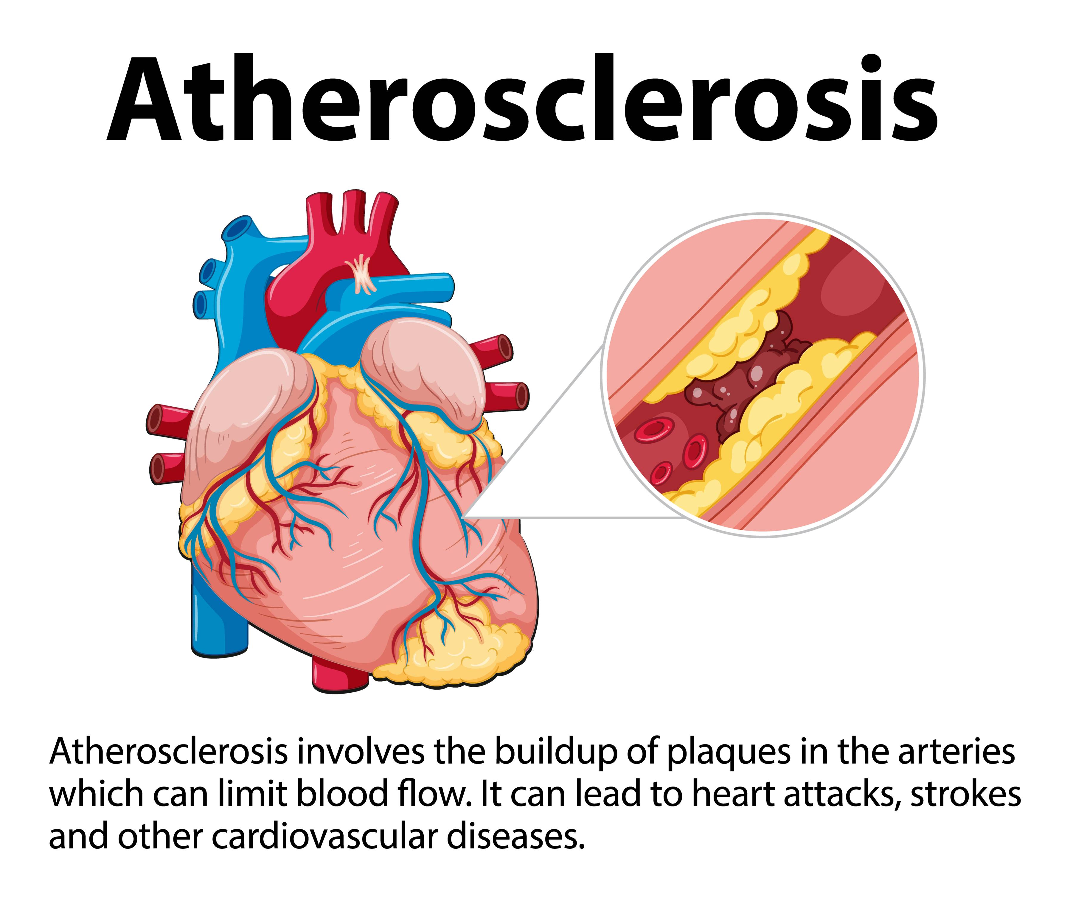 Understanding Aortic Valve Stenosis: Causes and Symptoms