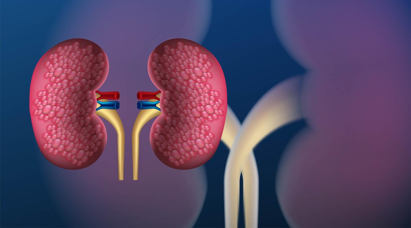 Understanding Kidney Stone Causes and Risks