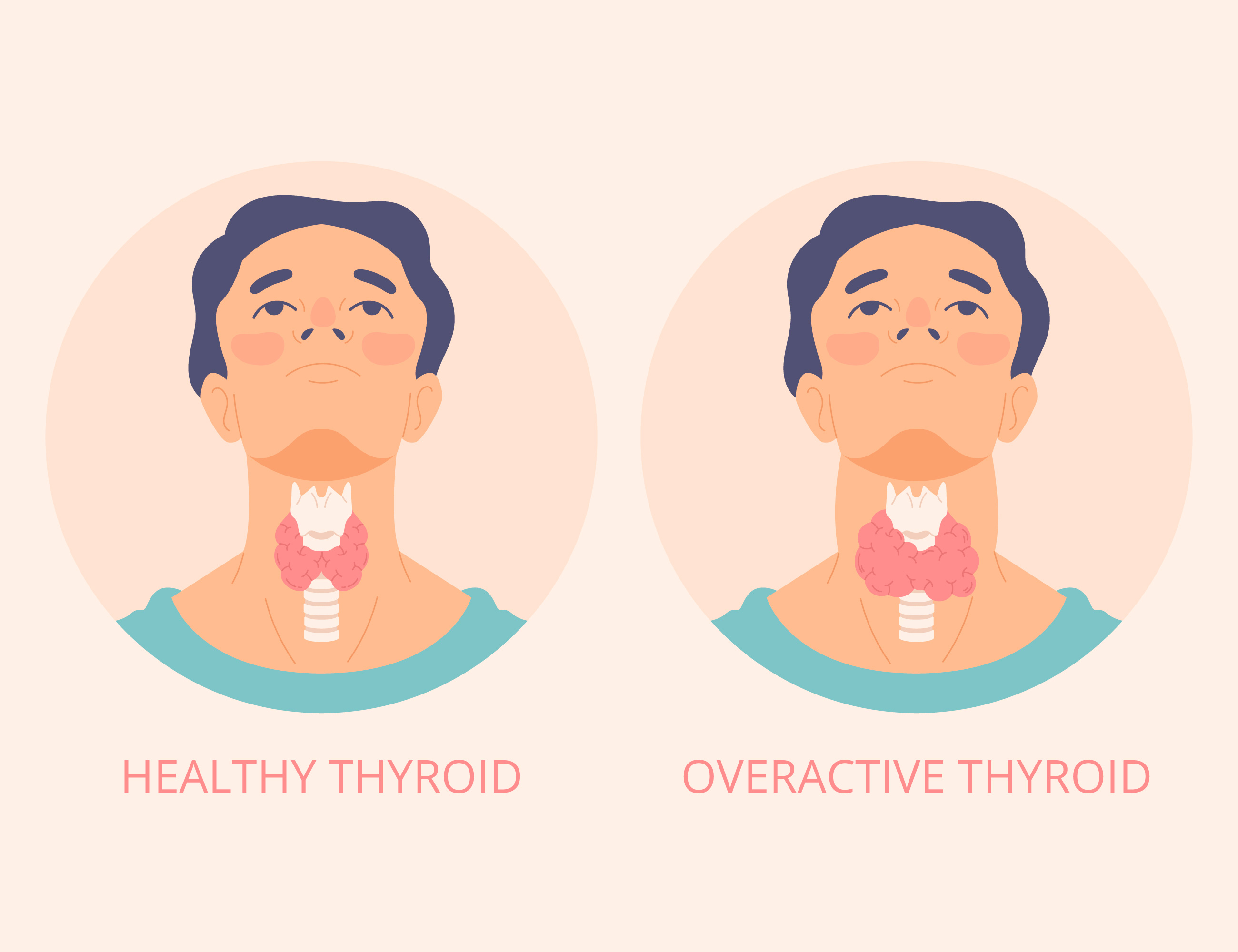 The Role of Hormones in Understanding Hypothyroidism: Causes, Symptoms, and Risk Factors
