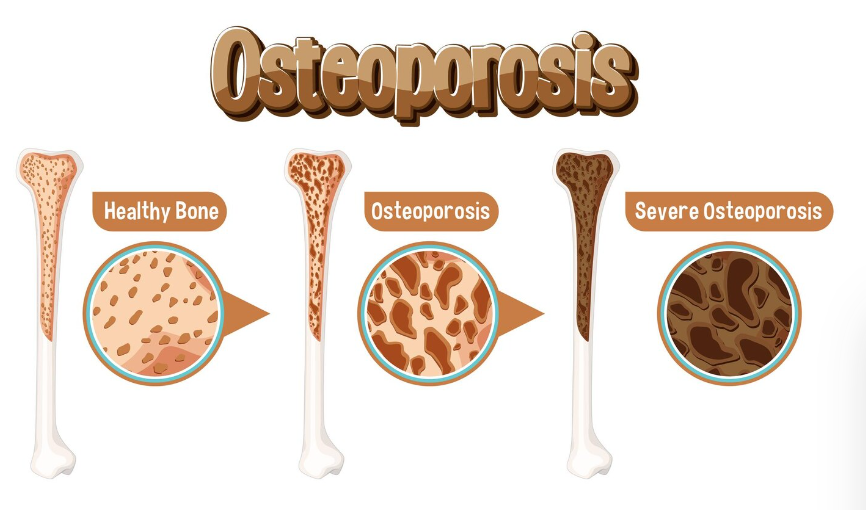 Types and Classification of Osteogenesis Imperfecta