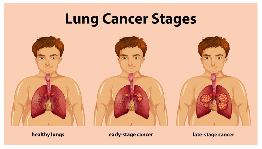 Lifestyle Changes to Manage and Prevent Lung Disease