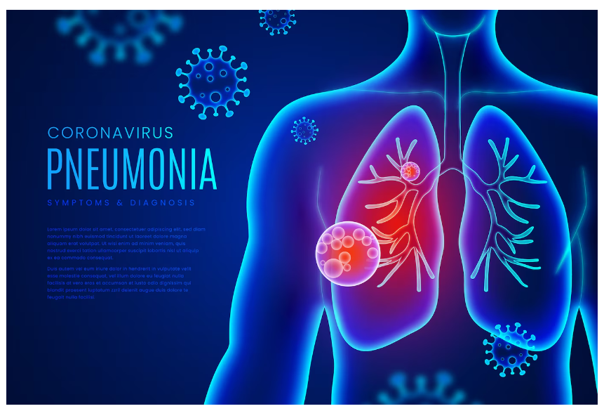 Understanding Pneumonia: Causes, Symptoms, and Risk Factors