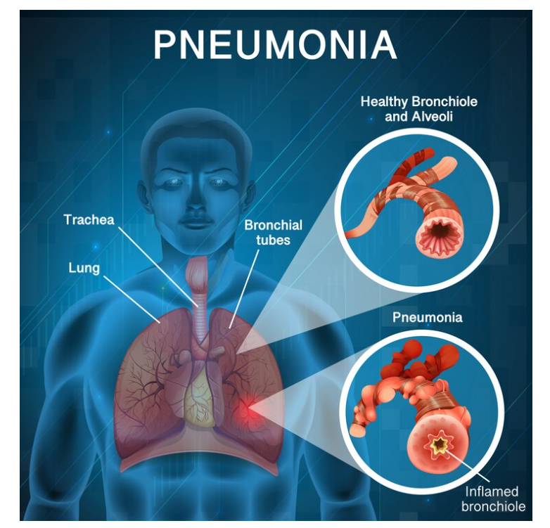 Different Types of Pneumonia: Viral, Bacterial, and Fungal