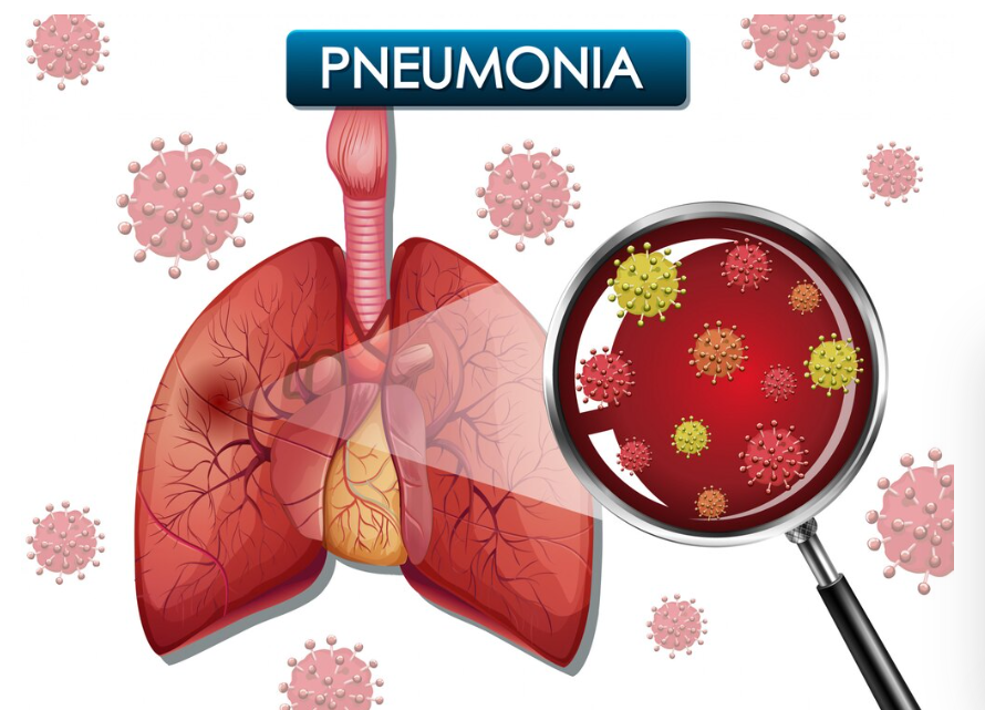Diagnosis and Treatment Options for Pneumonia: What to Expect