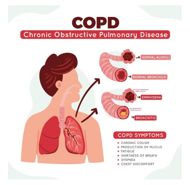 Understanding COPD: Causes, Symptoms, and Diagnosis