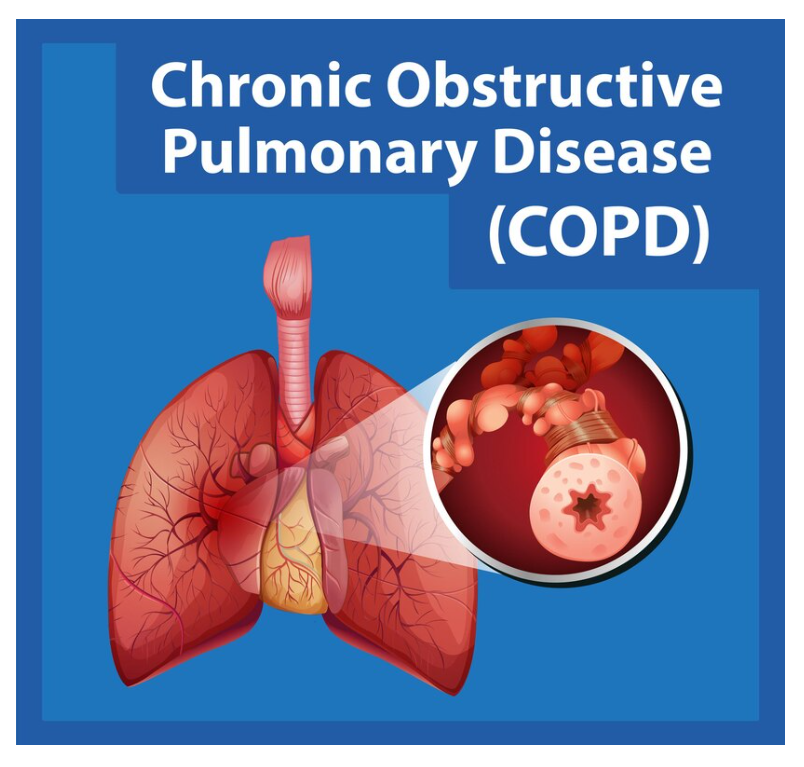 Living with COPD: Tips for Managing Daily Life