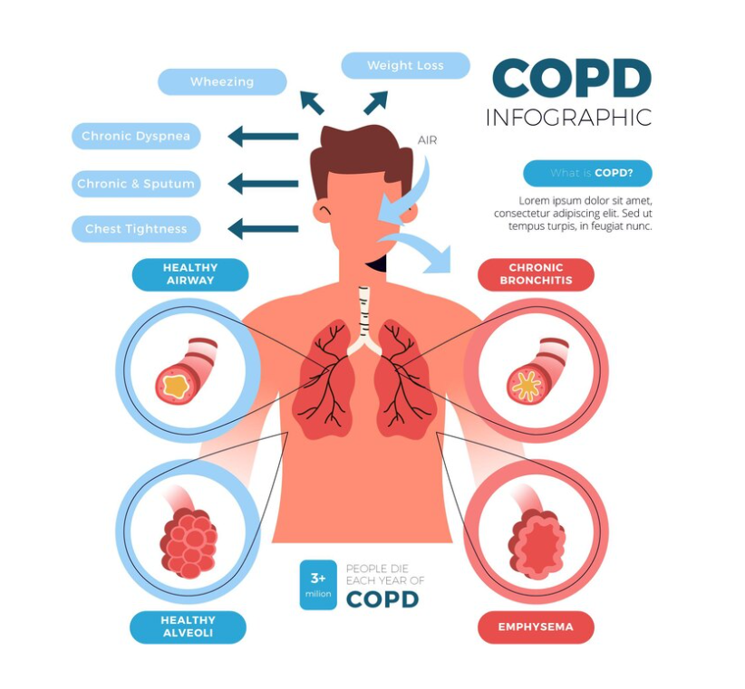 COPD Flare-ups: Recognizing Symptoms and Taking Action