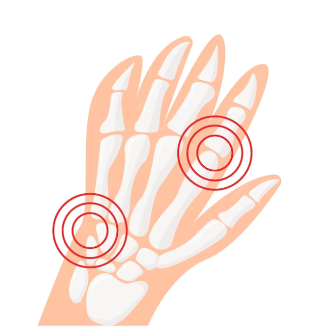 The Role of Hormones in Preventing Carpal Tunnel Syndrome: Tips and Strategies