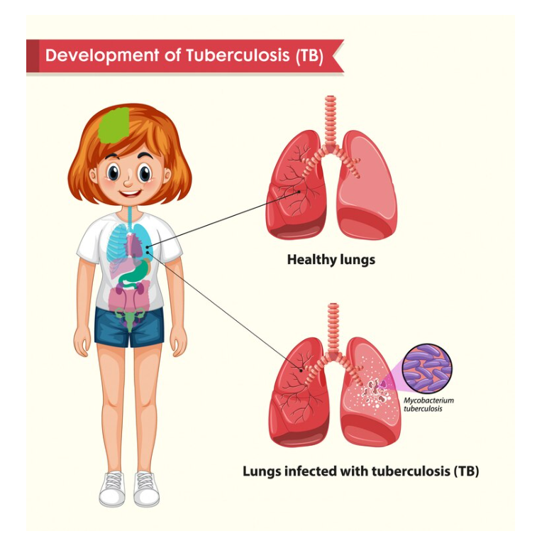 Tuberculosis in Children: Diagnosis, Treatment, and Long-Term Implications