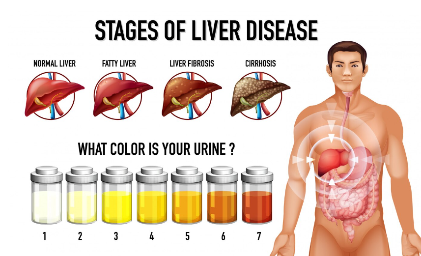 Symptoms and Signs of Fatty Liver Disease