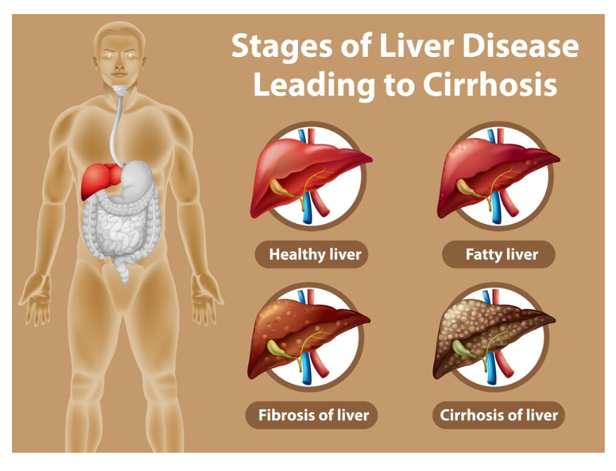 Complications of Advanced Fatty Liver Disease