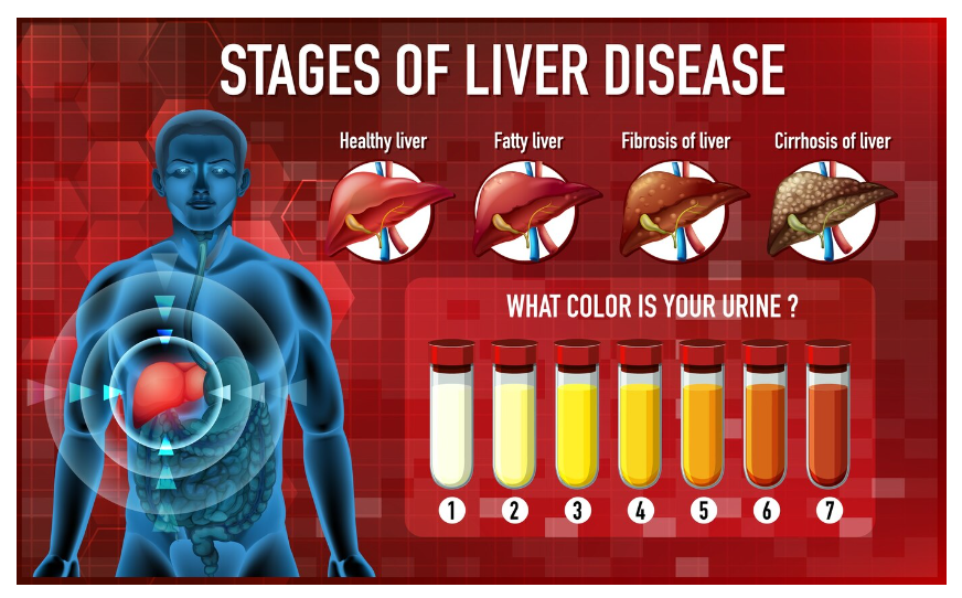 Preventive Measures for Fatty Liver