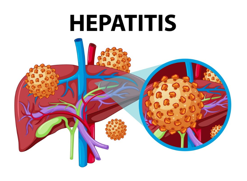 Hepatitis D and E: Lesser-Known Types Explained