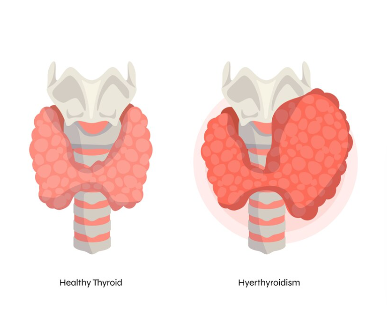 The Role of Hormones in Hyperthyroidism vs. Hypothyroidism: Understanding the Differences