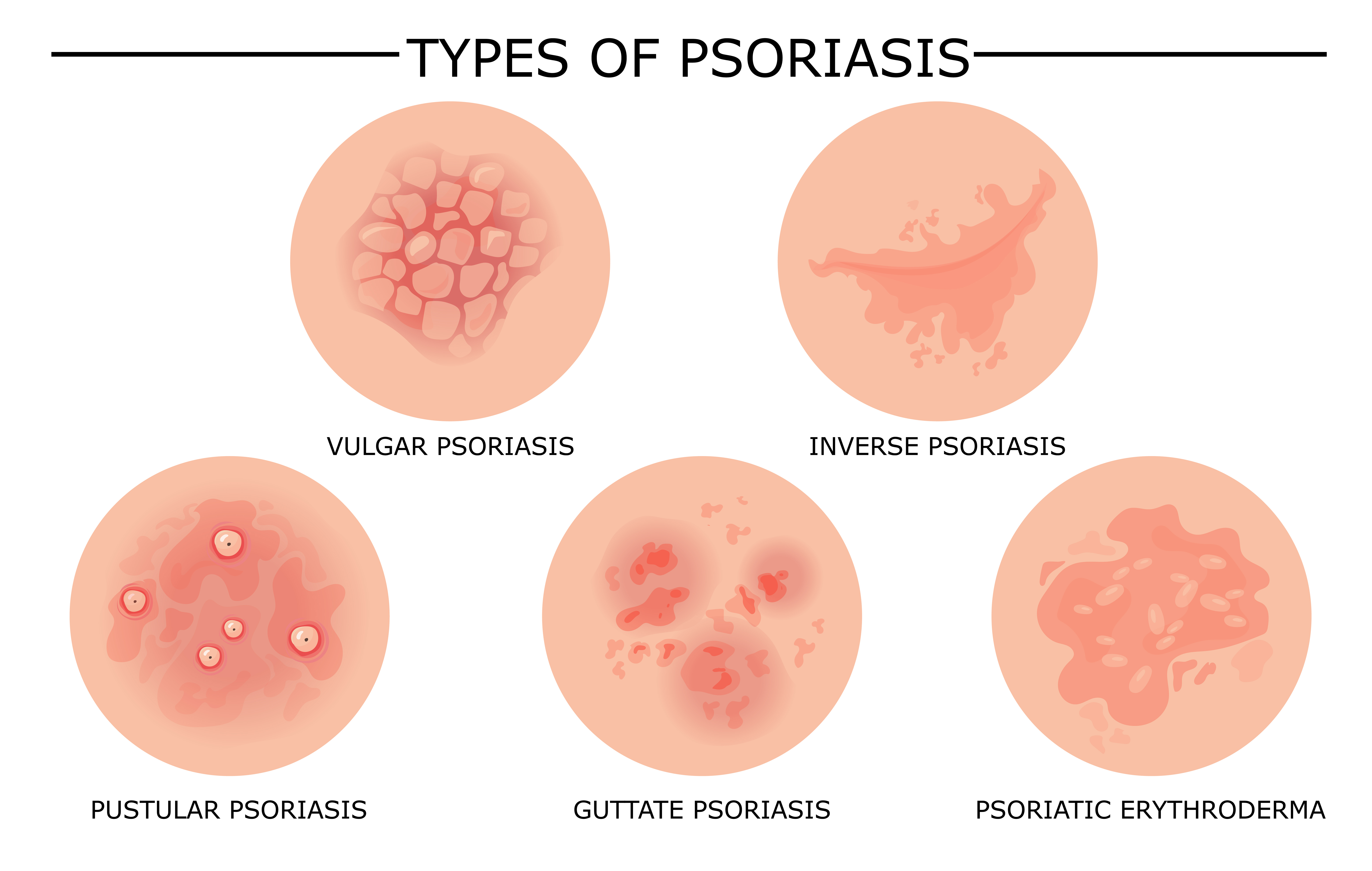 Tips for Managing Psoriasis Flare-Ups: Soothing Symptoms & Preventing Recurrences