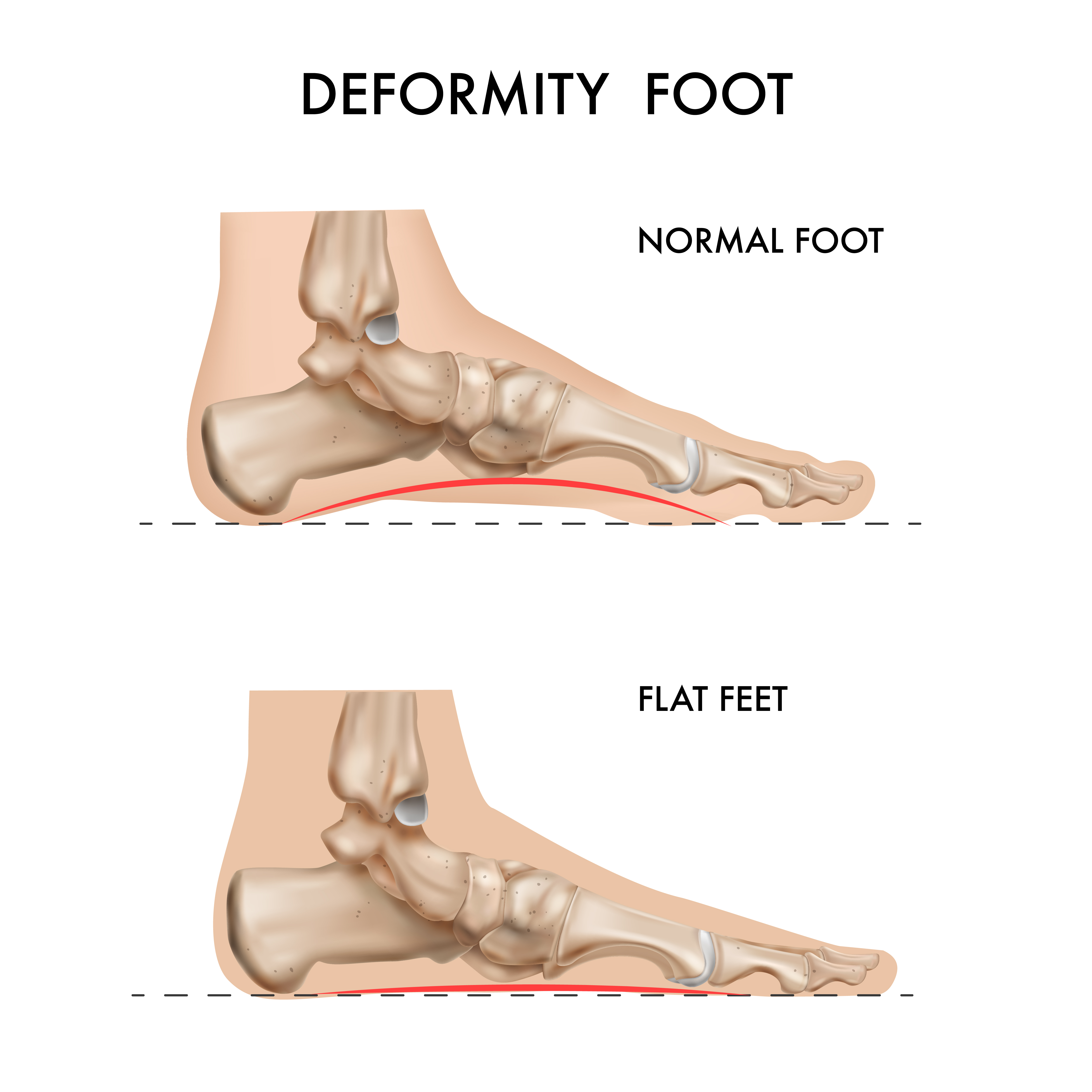 The Role of Hormones in Diabetic Neuropathy: Nerve Damage and Its Impact on Foot Health