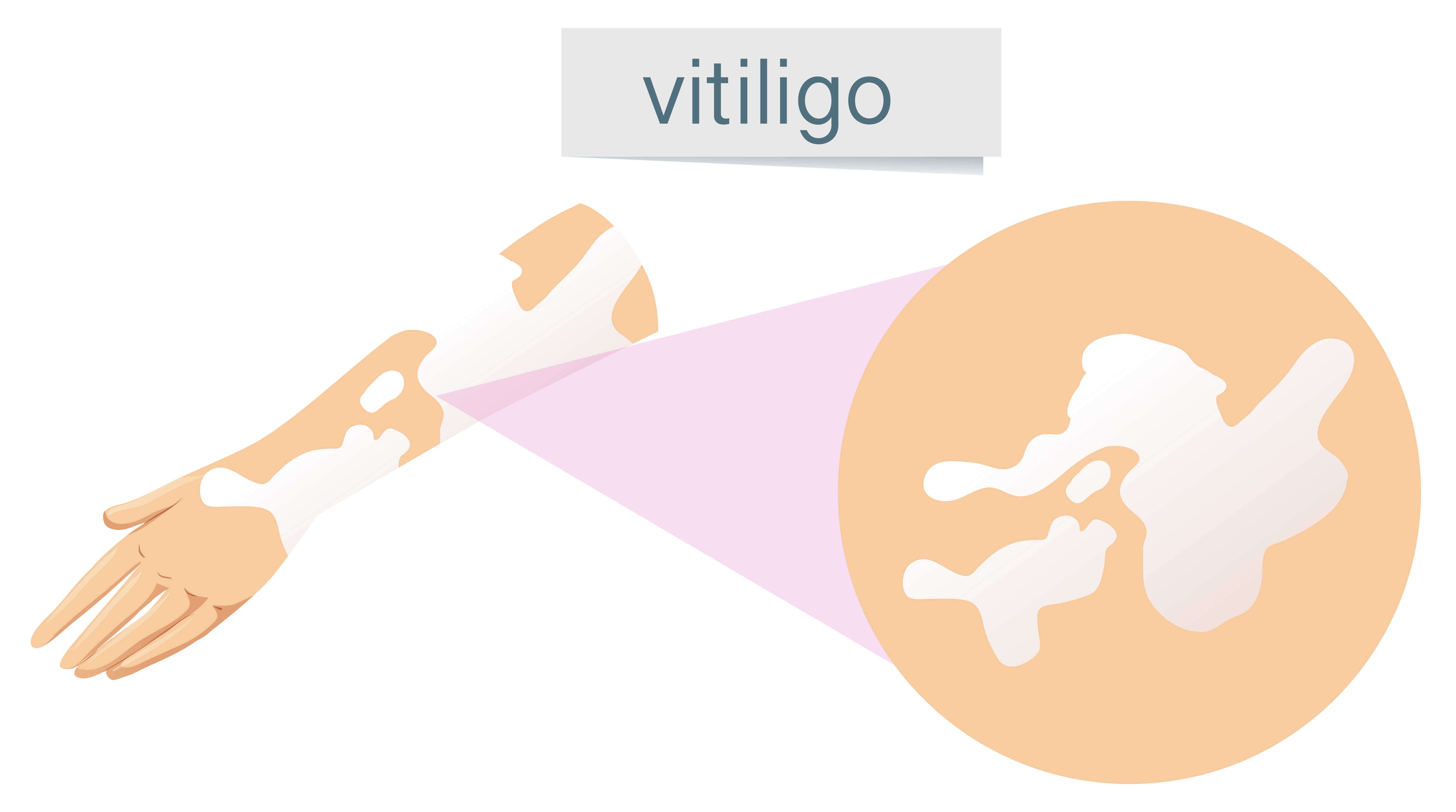 Understanding Vitiligo: Segmental, Non-Segmental, and Mixed Types