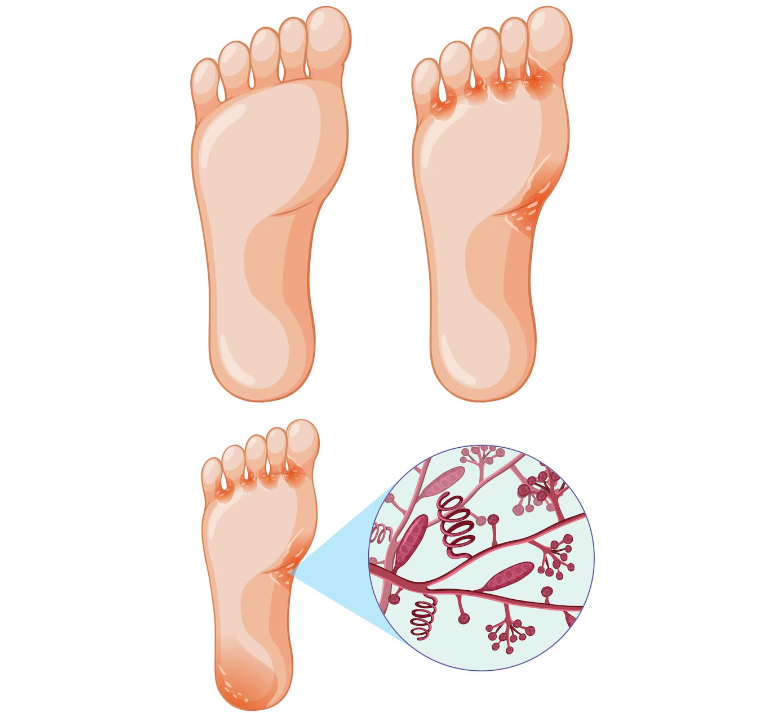The Role of Hormones in Preventing Infections in Diabetic Foot: Tips for Proper Wound Care