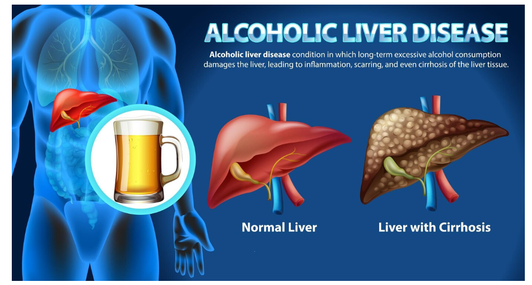 Understanding Non-Alcoholic Fatty Liver Disease (NAFLD): Exploring its Causes and Risk Factors