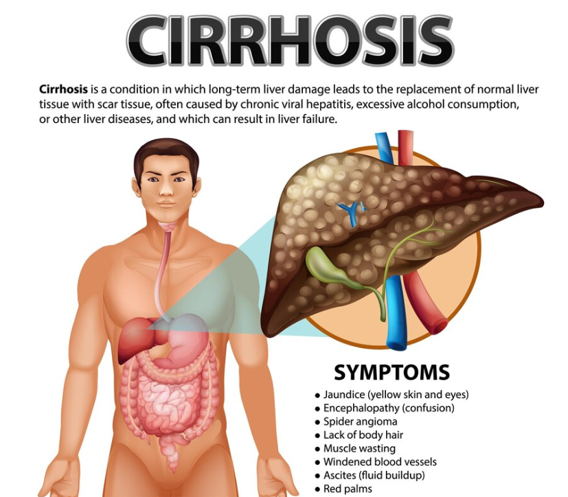 Hepatitis C and Cirrhosis: What You Need to Know