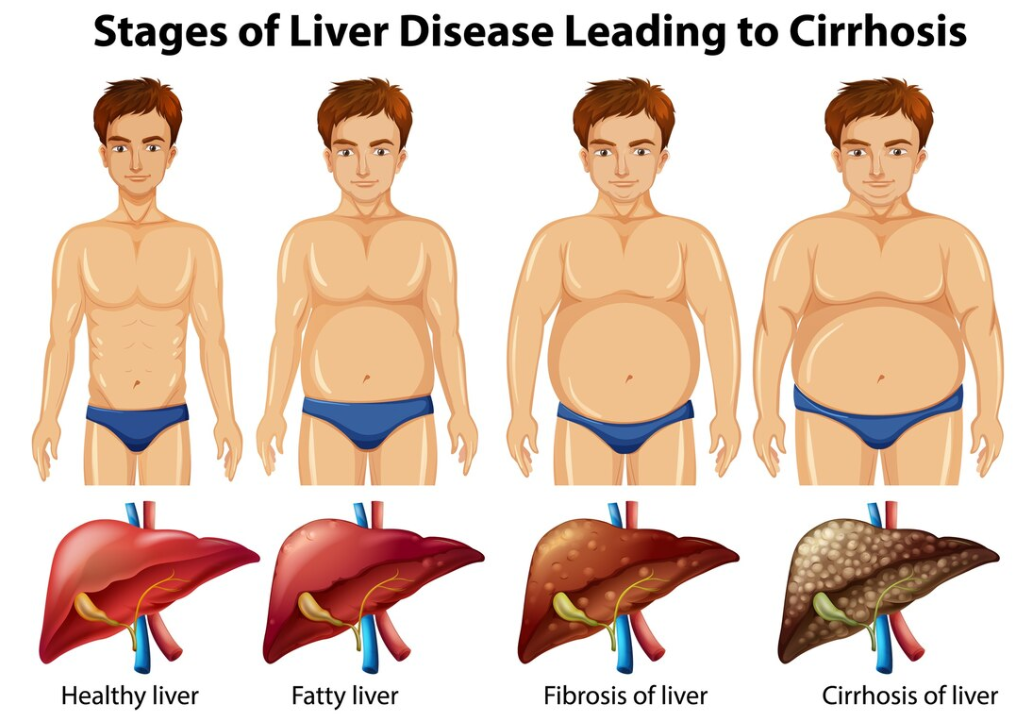 Lifestyle Changes to Improve Liver Health and Prevent Cirrhosis