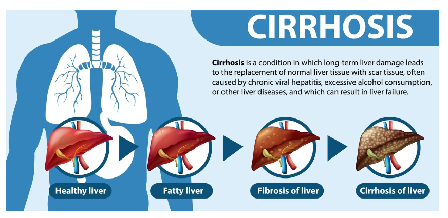 Complications of Cirrhosis: Ascites, Varices, and Hepatic Encephalopathy