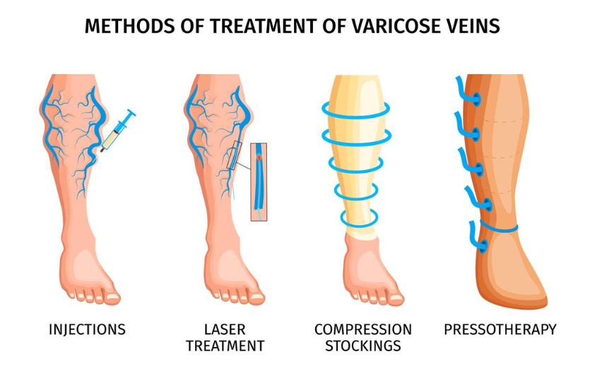Causes of Varicose Veins: Unraveling the Factors