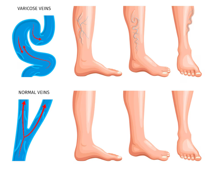 Symptoms of Varicose Veins: Recognizing the Signs