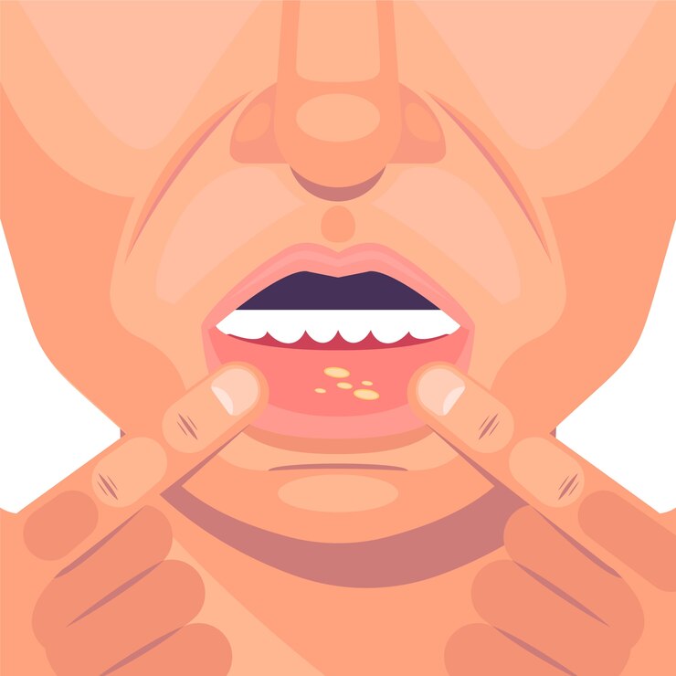 Understanding Cleft Mouth Ulcers: Causes, Symptoms, and Triggers